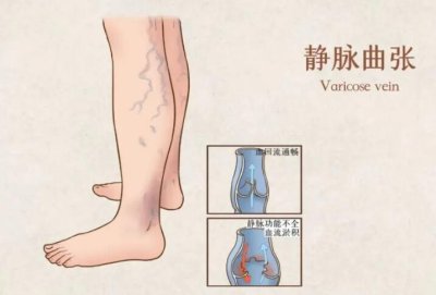 靜脈曲張困擾女性健康怎么辦   如何做好護理